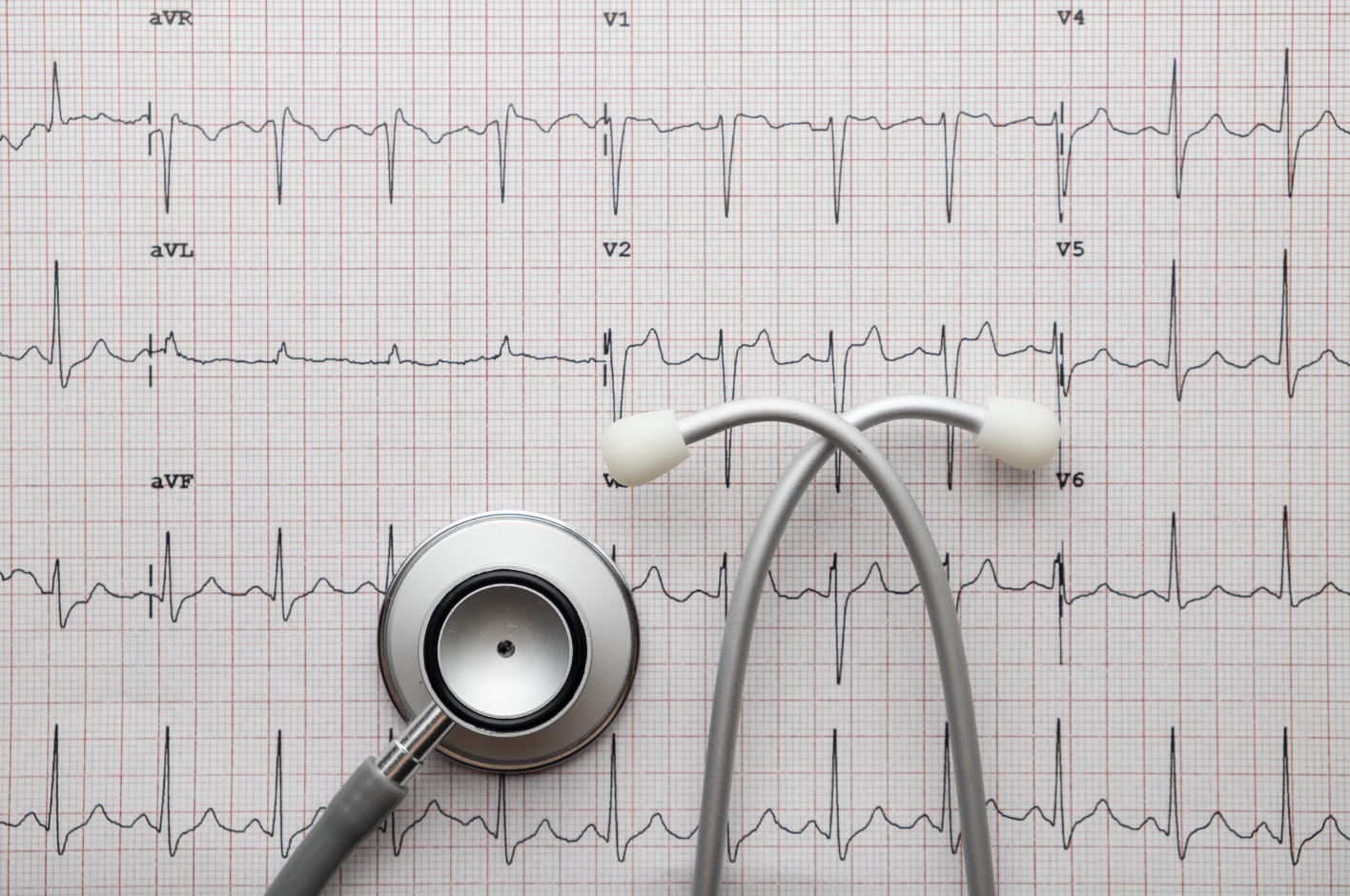 stress electrocardiogram